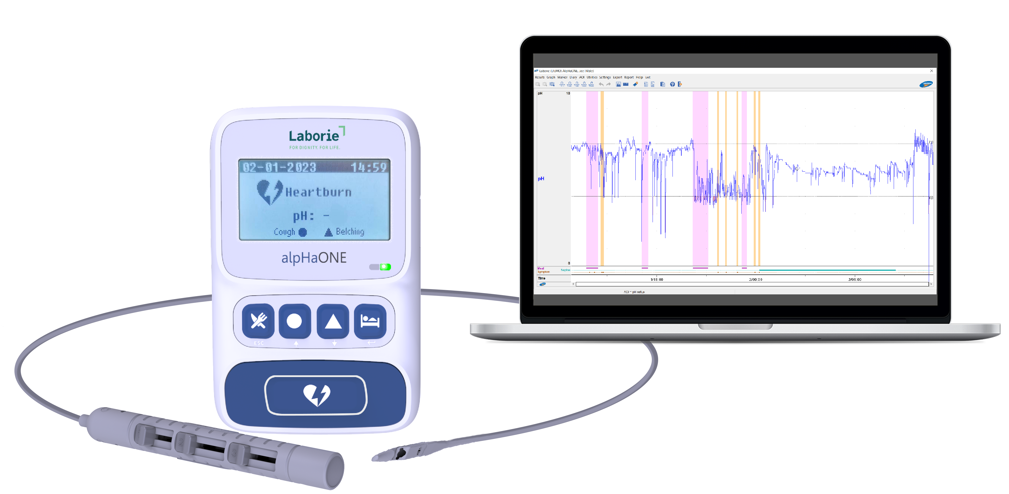 alpHaONE Wireless pH Capsule Reflux Monitoring System for the Treatment of GERD